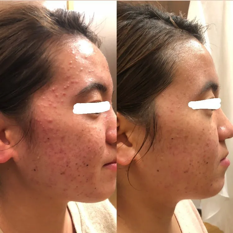 フェイシャルビフォーアフター